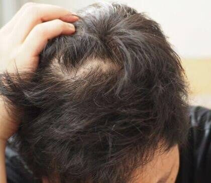 Flaking & Scalp Buildup - Baby Hair hair care education